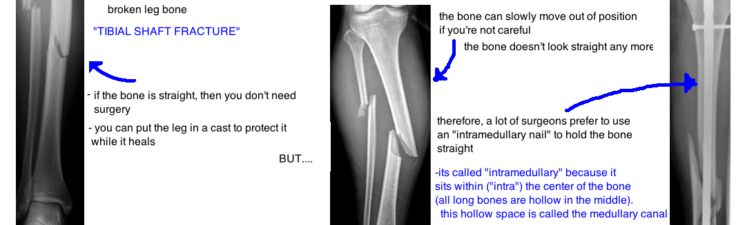Broken Leg: If my tibial shaft fracture gets surgery, when can I start  walking on it? — Bone Talks