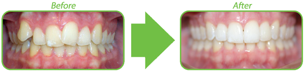 ClearCorrectbefore and after.png