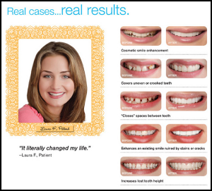 Snap on Smile