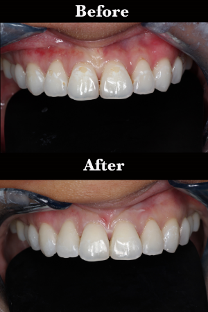 Honolulu Best Dentist in Hawaii Dr Wade Takenishi- Hypocalcification removal.jpg