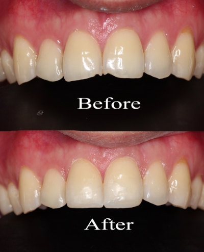 How to Fix a Chipped Tooth  The Center for Cosmetic Dentistry