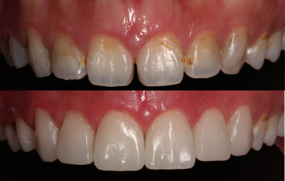 Can Dentist Get Rid of Yellow Stains?
