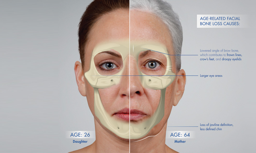 foto: SF Bay Cosmetic , tvárový skelet u 26 ročnej dcéry a 64 ročnej matky