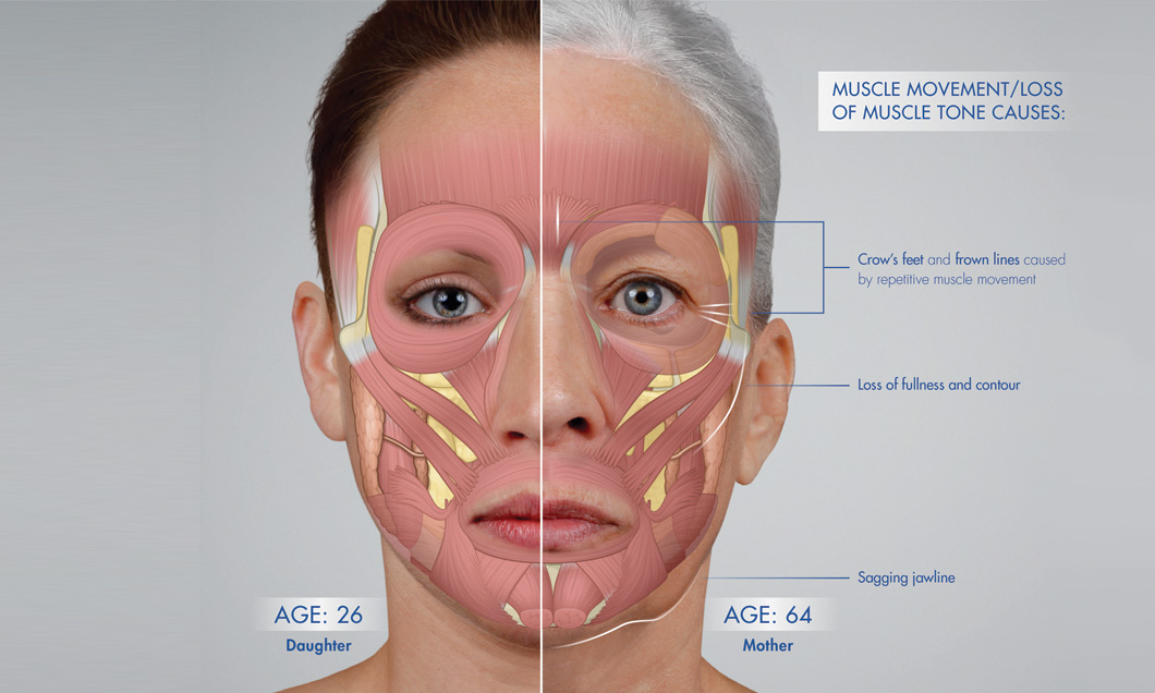 foto: SF Bay Cosmetic , relaxovať tvárové svalstvo dokáže napr. botox, a tým aj preventívne zabrániť vzniku jemných liniek a vrások