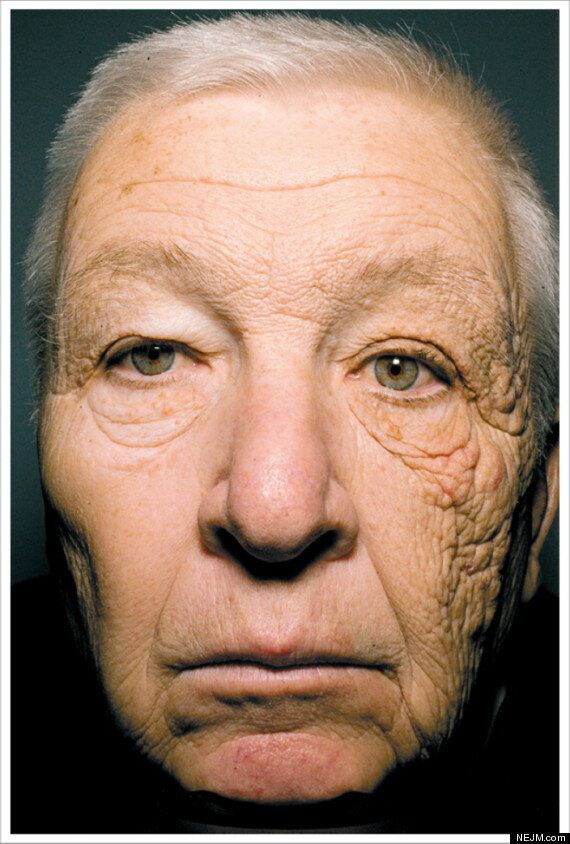 Toto sa volá unilaterálna dermatohelióza a pánovi McElligottovi odporučili dermatológovia tri veci- lokálne retinoidy, SPF a rakovinový monitoring, foto: The New England Journal of Medicine