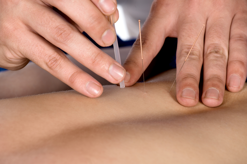 dry needling.png