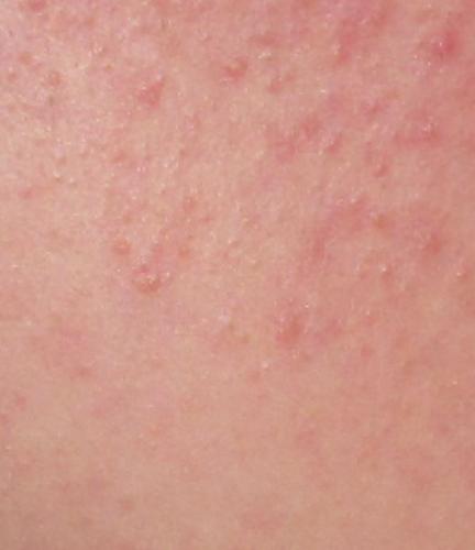 hpv face acne ciclu de viață larg al panglicii