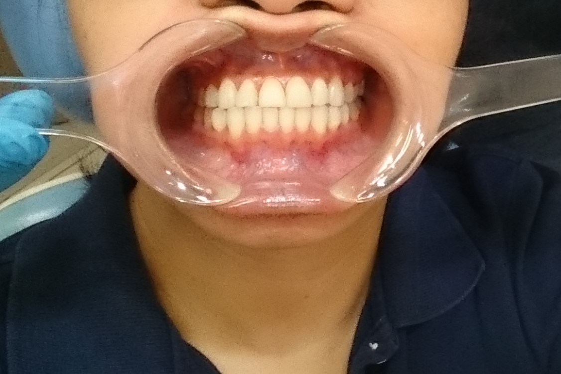 Before the procedure