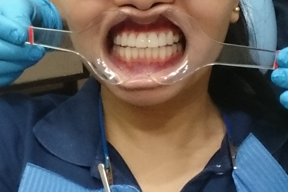 After the procedure - the change is subtle but my smile looks so much better!