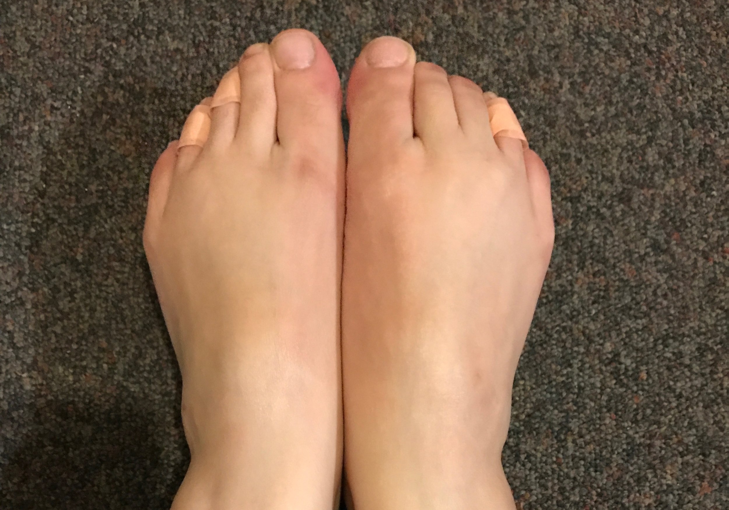 Saying goodbye to my ugly feet before I use Baby Foot!