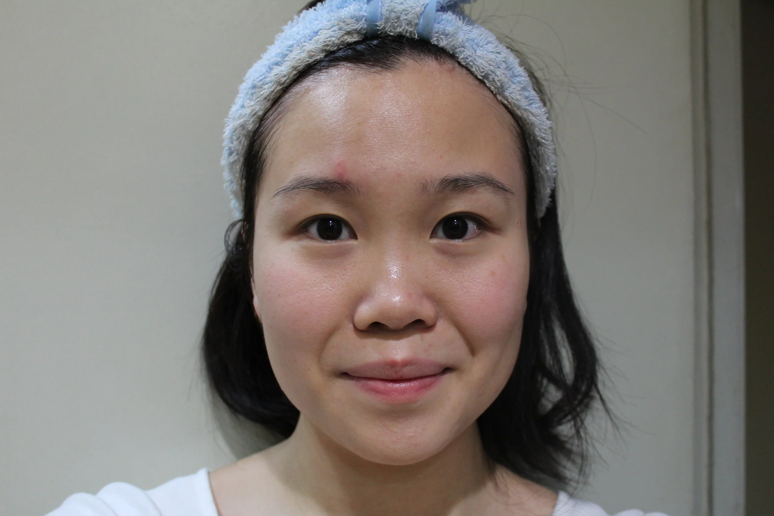A Bright Solution: How the Freshel Whitening Gel fixed my flaky, dull ...