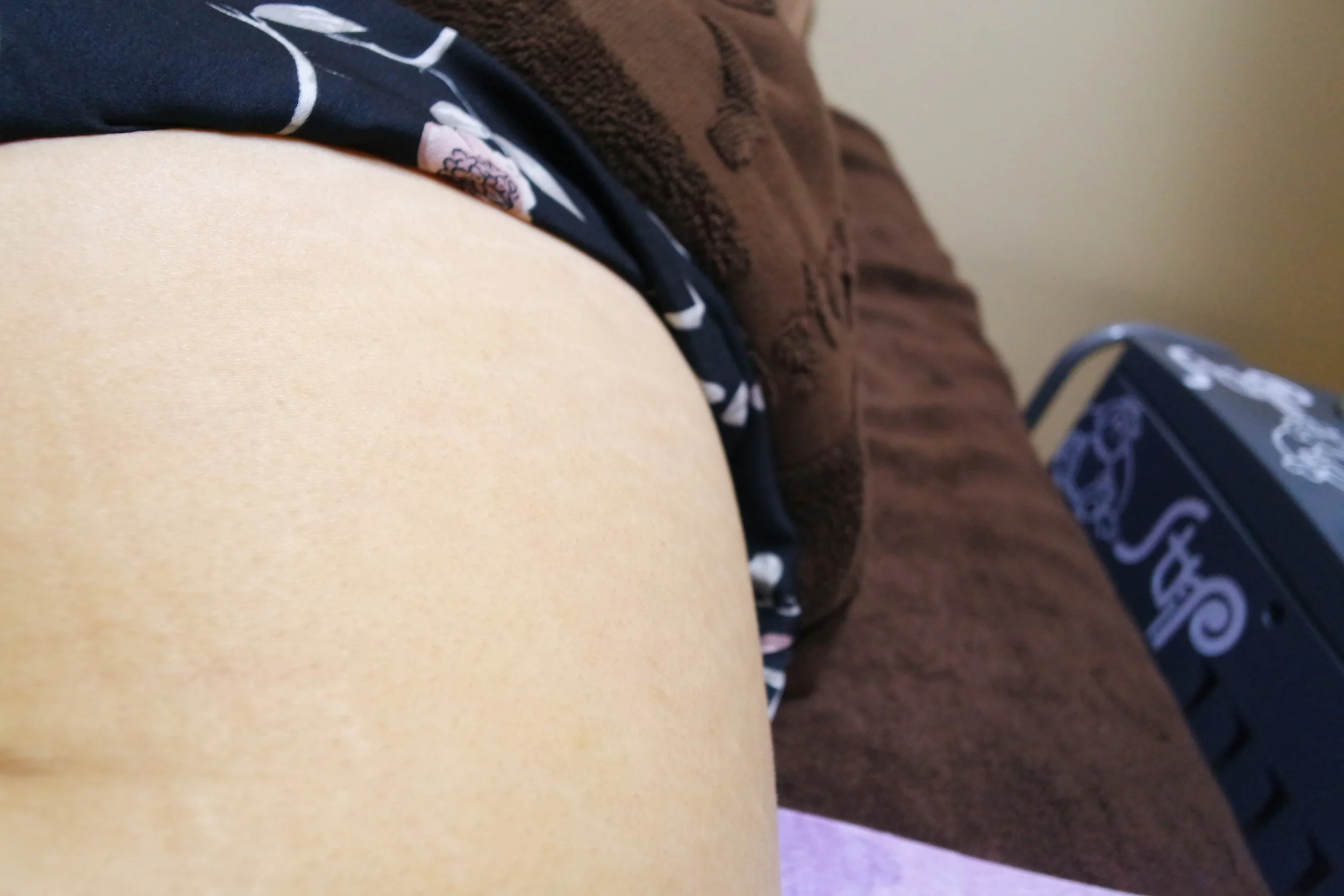 True Story How I Made My Stretch Marks Disappear In 15 Minutes