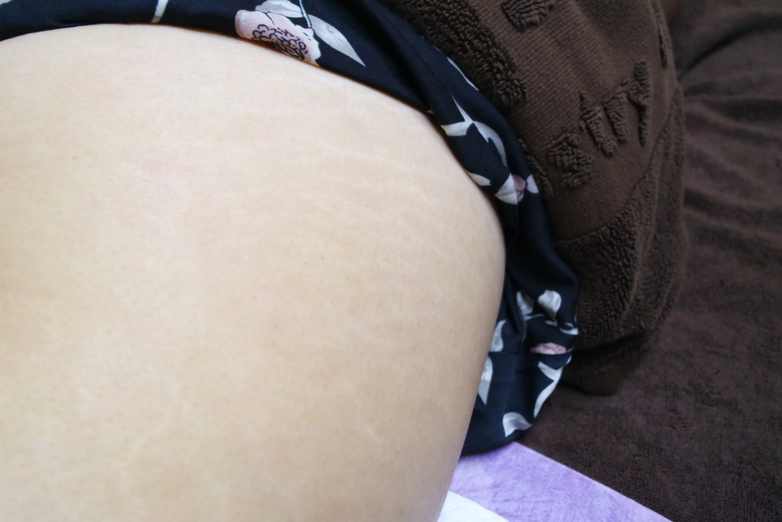 This photo clearly shows the difference between the treated area (left) and the untreated area (right). The laser was only applied on my butt cheeks and not my thighs.