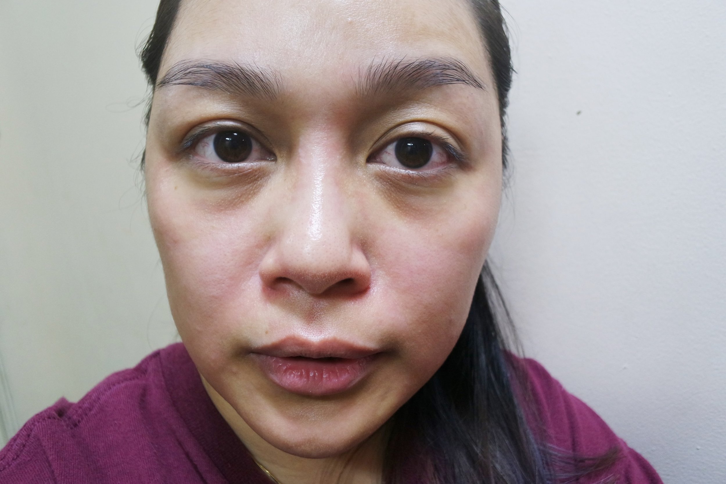My skin turns red and bumpy when I over-exfoliate
