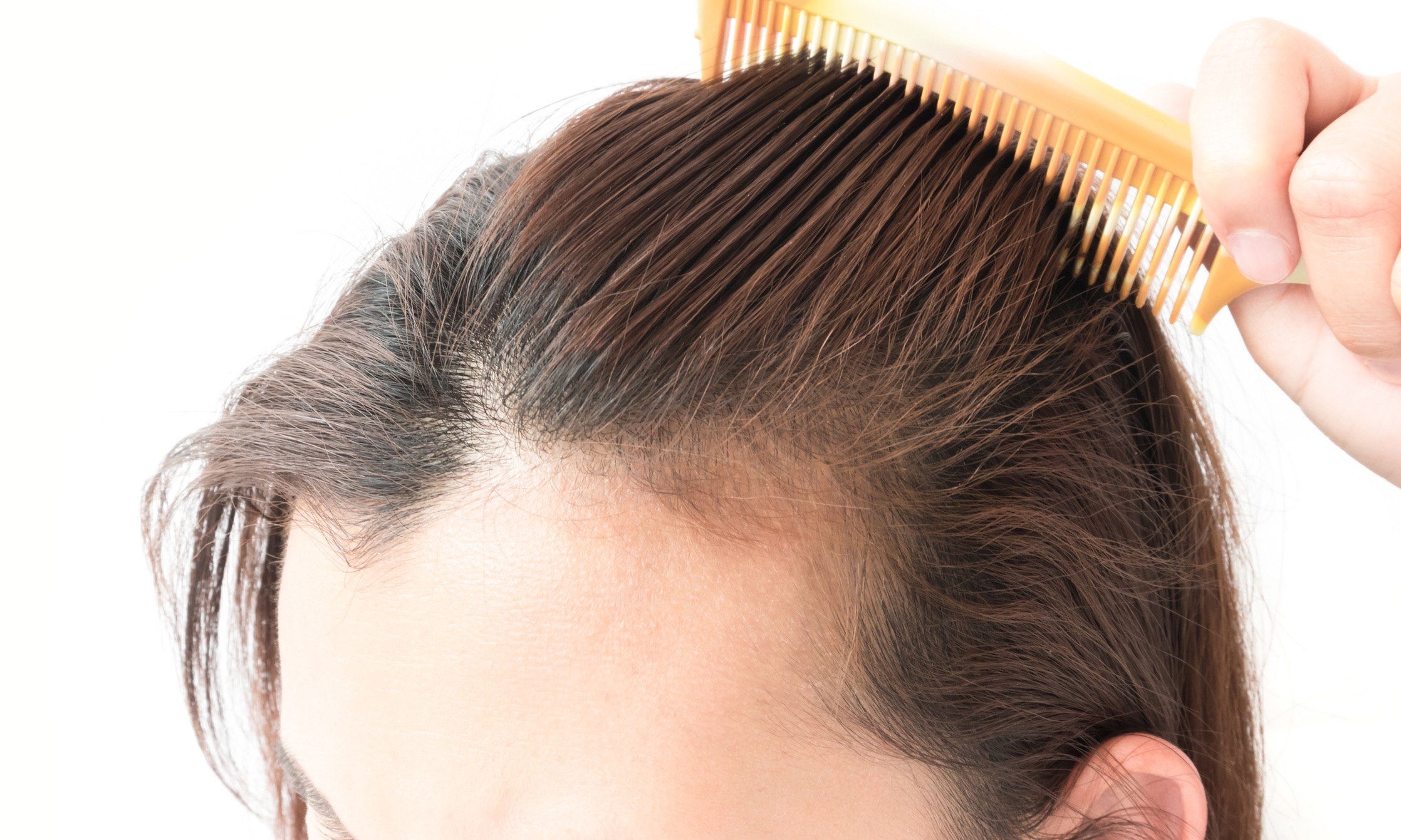 Отзывы врачей выпадение волос. Выпадение волос у женщин.