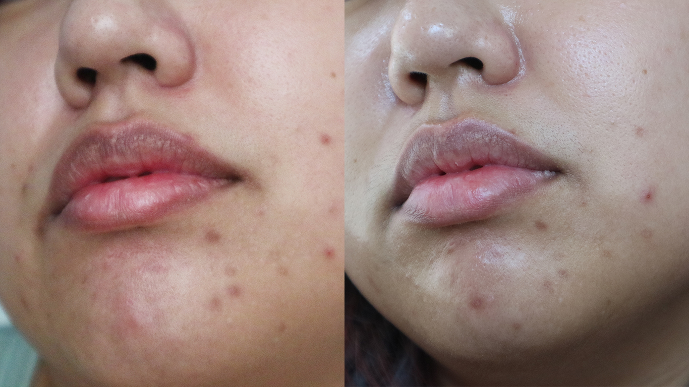Before and After: Not a marked improvement but you can see some fading. My face definitely feels a lot smoother though.