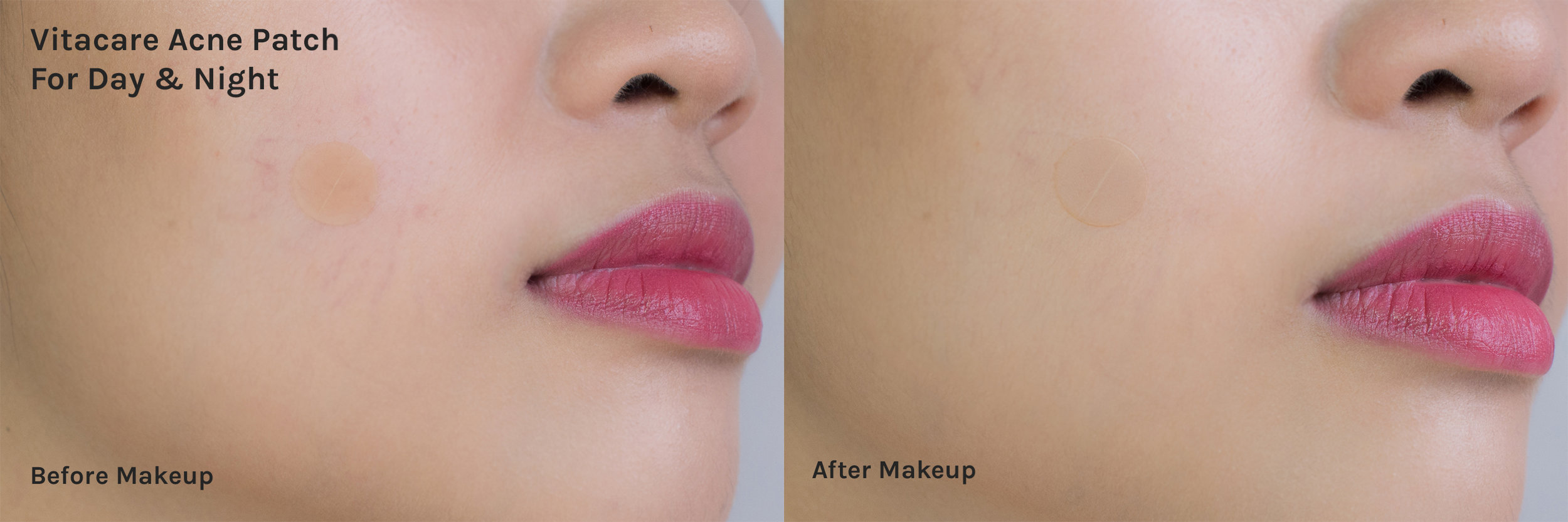 pimple patches under makeup Pimple patches inflammatory acne acnee
plasture beautyshop ventussa
