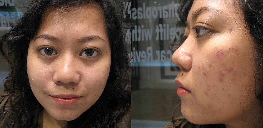 What my skin looked like in my early 20s. I share this photo every once in a while to remind myself how bad it was.