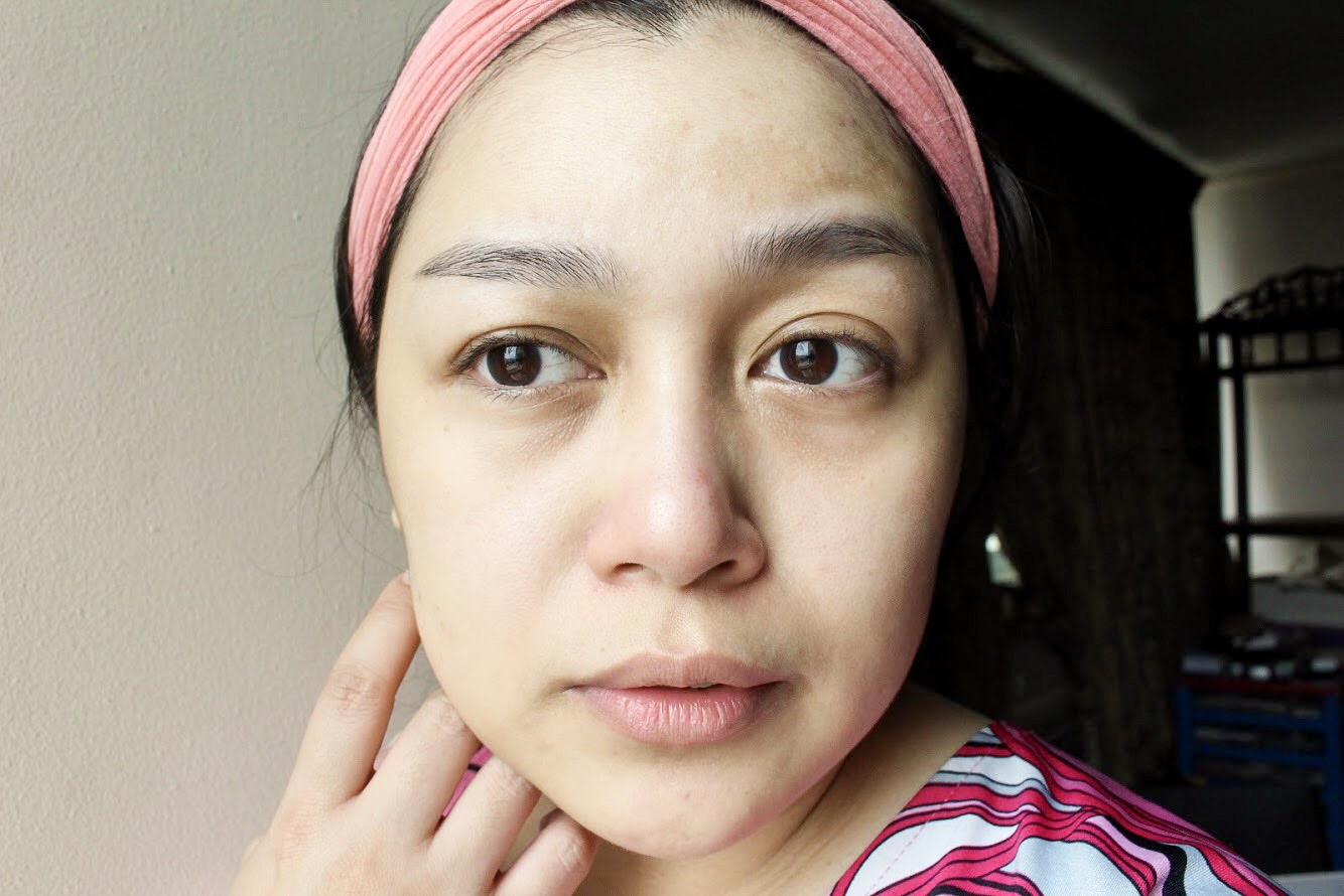 After: Brighter complexion, pimple are less red, no more flakiness