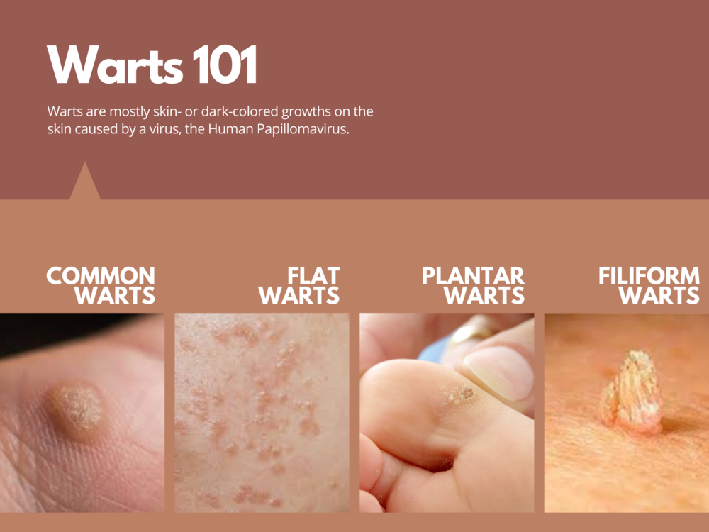 Warts on skin types