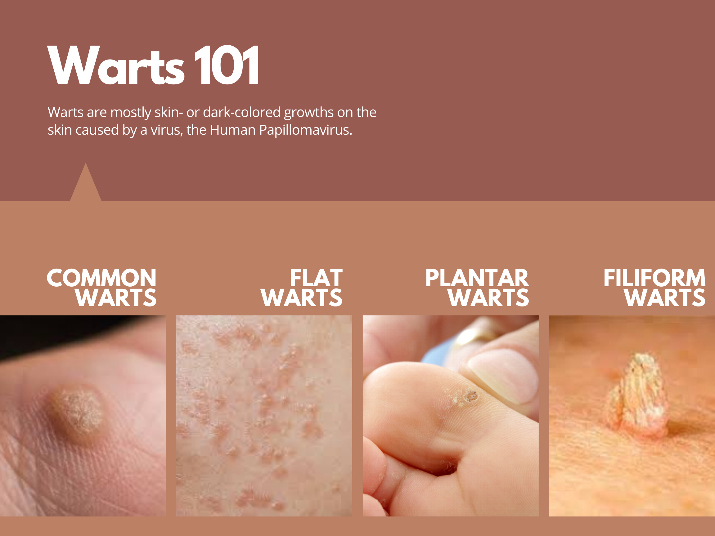 What Do Warts Look Like On Hands Infoupdate What Do Warts Look Like On Hands Infoupdate