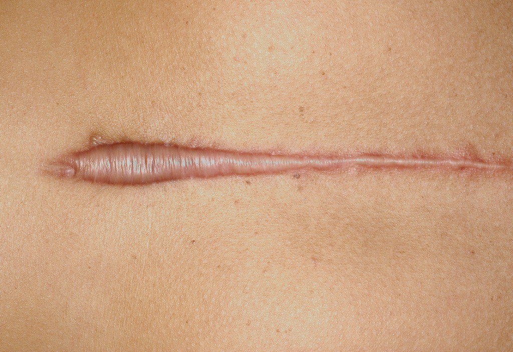 Hypertrophic Scar: Treatment, Causes, Image, and More