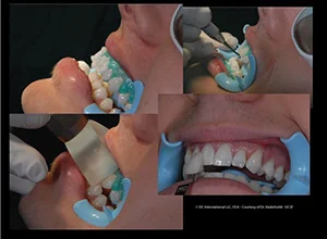 clareamento com DC Laser