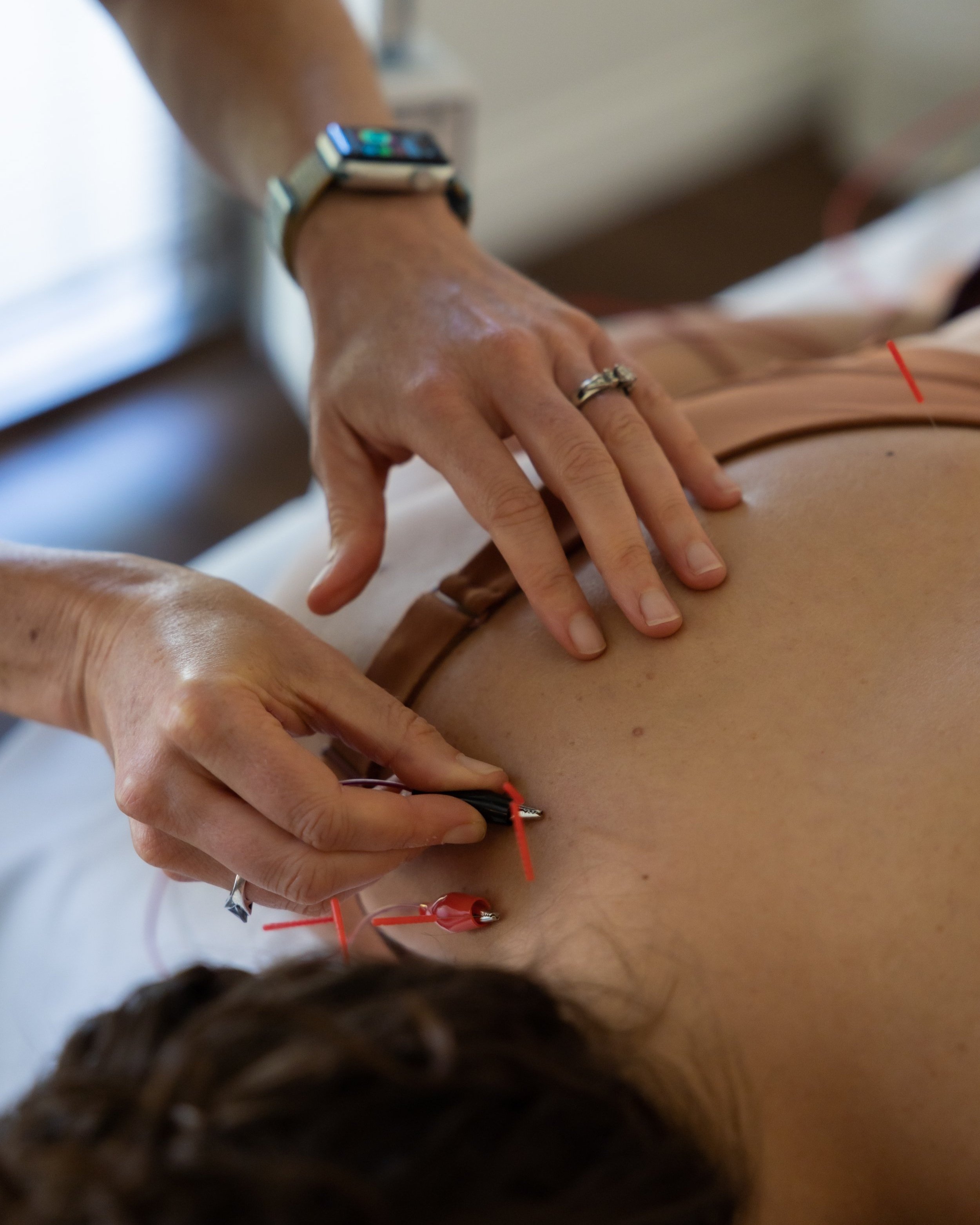 Sydney Remedial Massage  Dry Needling and Electro-Dry Needling - What Is  the Difference? - Sydney Remedial Massage