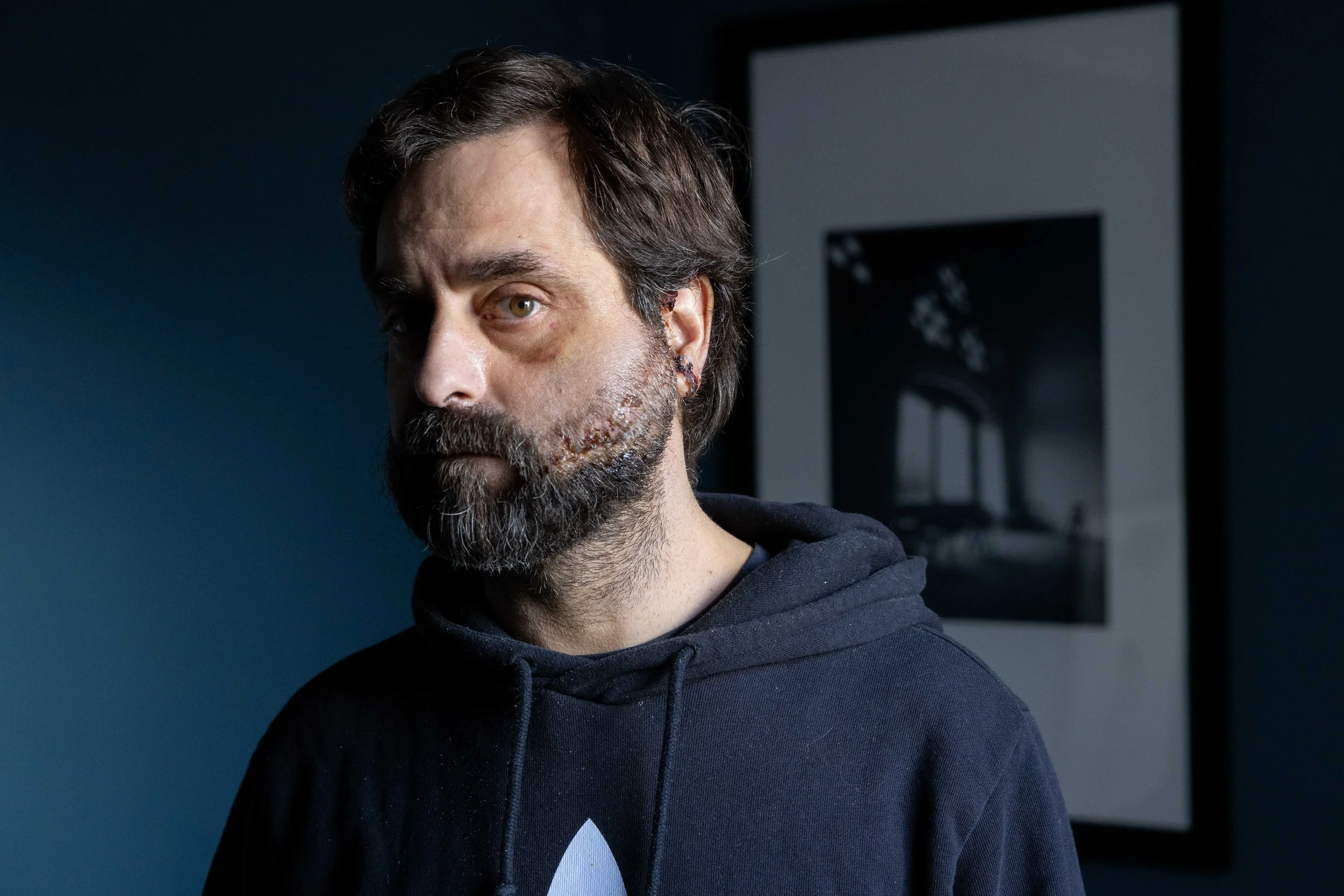  Martin Olive poses for a portrait at his home in San Francisco on Wednesday, Feb. 5, 2025. Olive was shot six times in an unprovoked attack in January. (Amanda Andrade-Rhoades/The San Francisco Standard) 