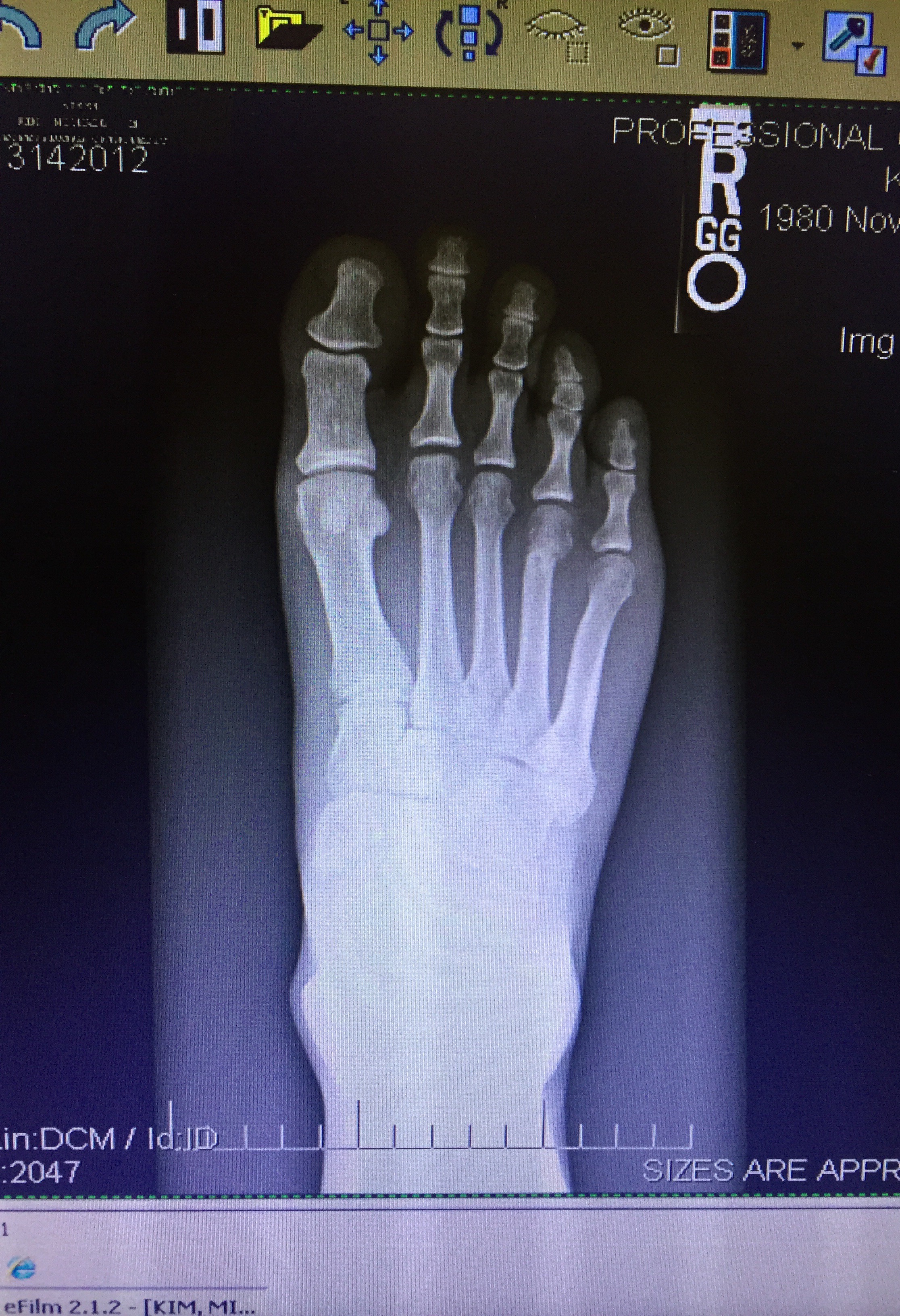 (x rays showed a slight fracture on the 4th metatarsal)