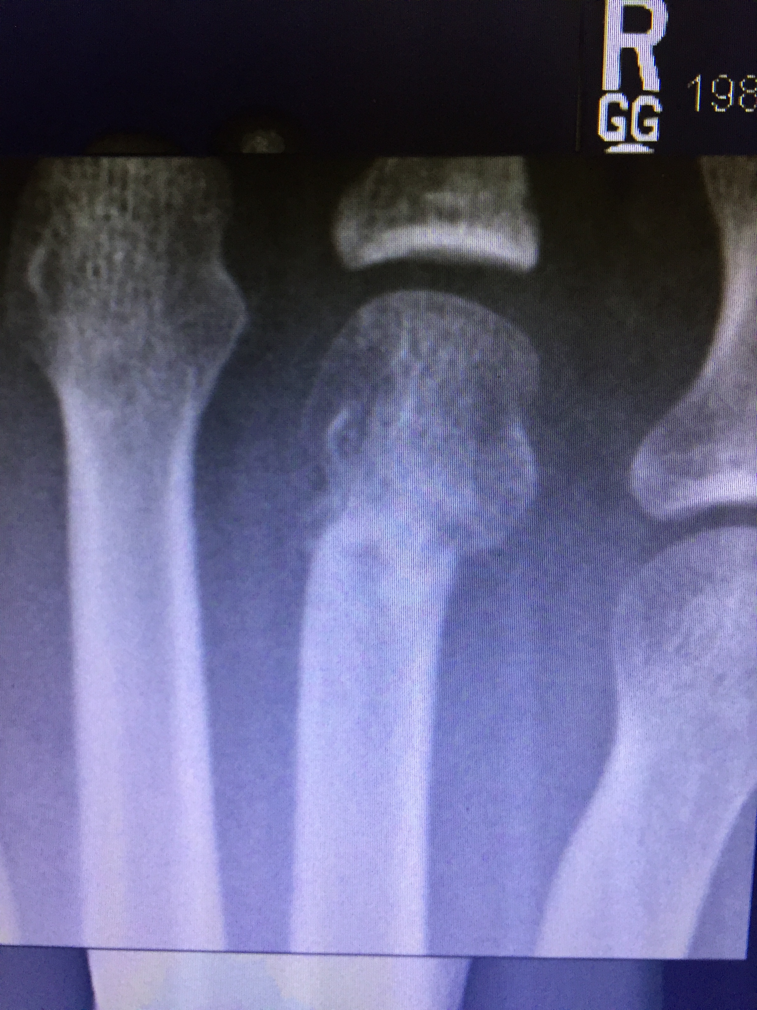 (these are both the after photos which so the calcification of the fracture which is part of the healing process)