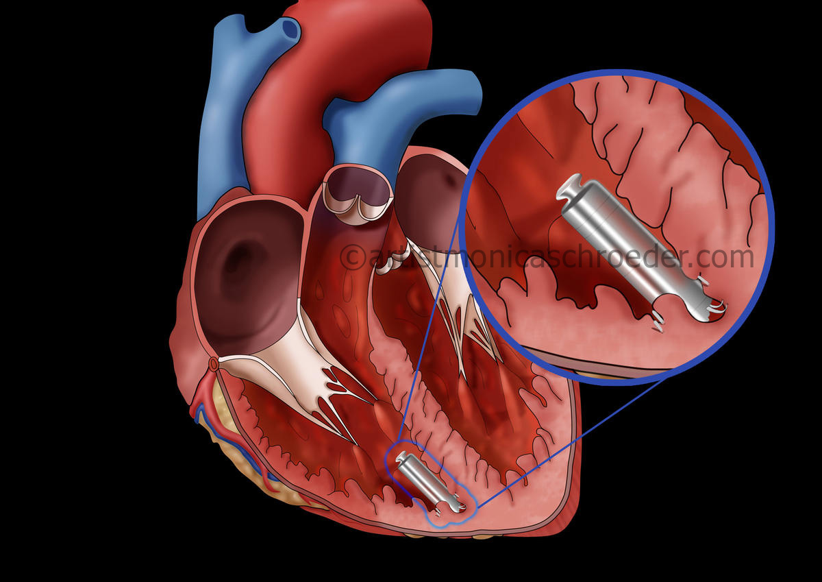 Pacemaker Implanted Inside the Heart