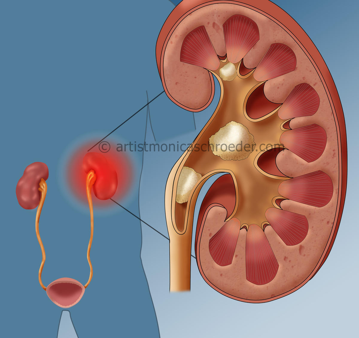 Kidney Stones