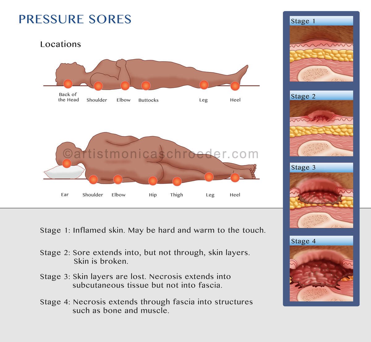 Common Bed Sore Locations, Diagram