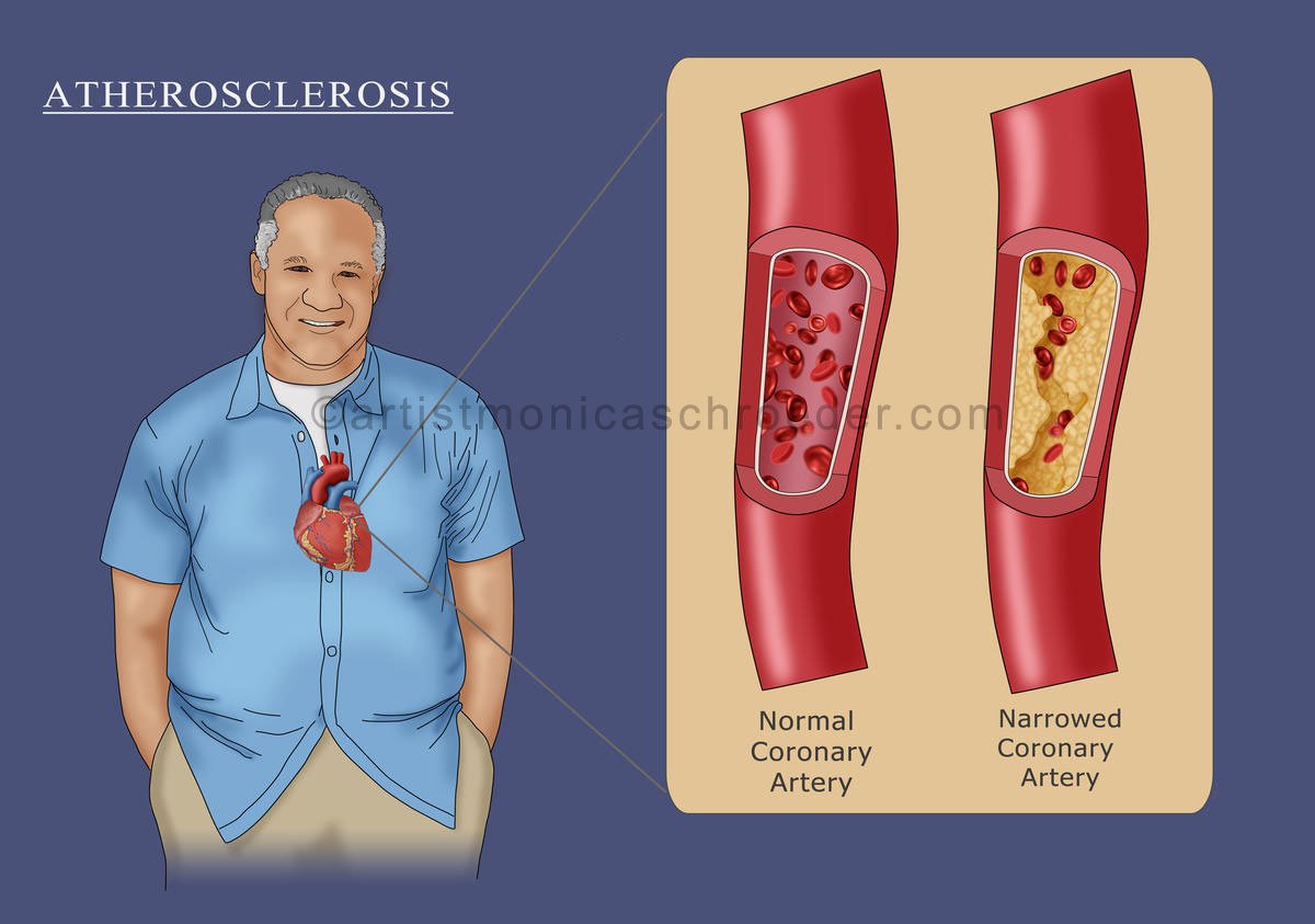 Atherosclerosis in a Black Man