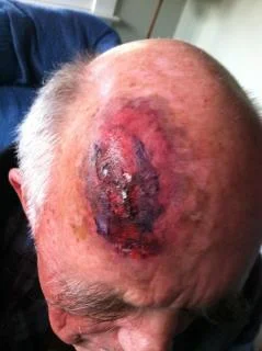 Head wound, the next day.