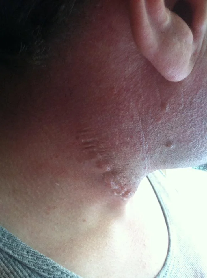 Scar