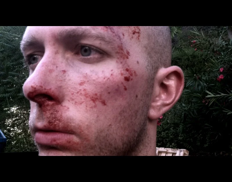 Bloody nose, splatter, and scraping