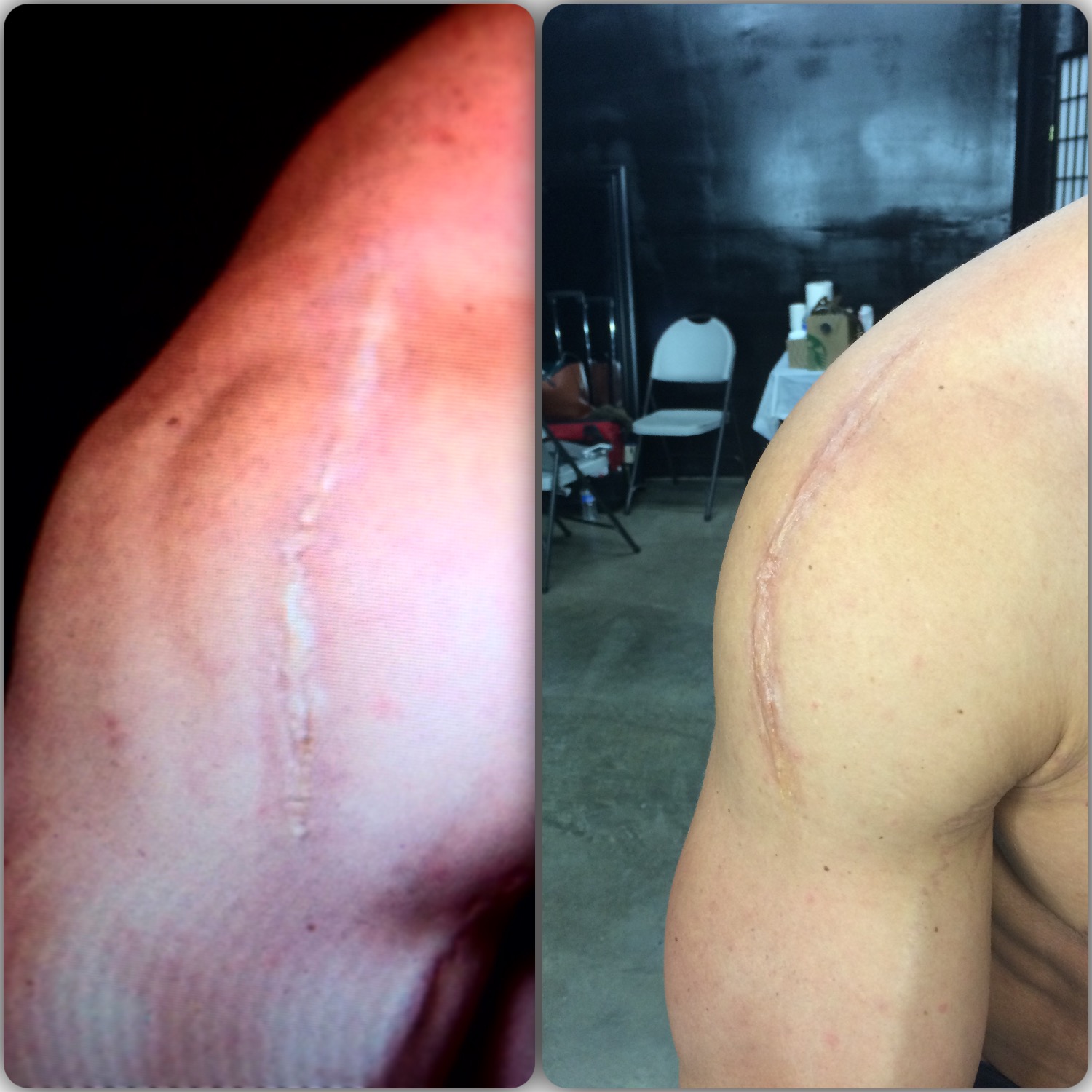 Scar, first picture from the monitor, second in person