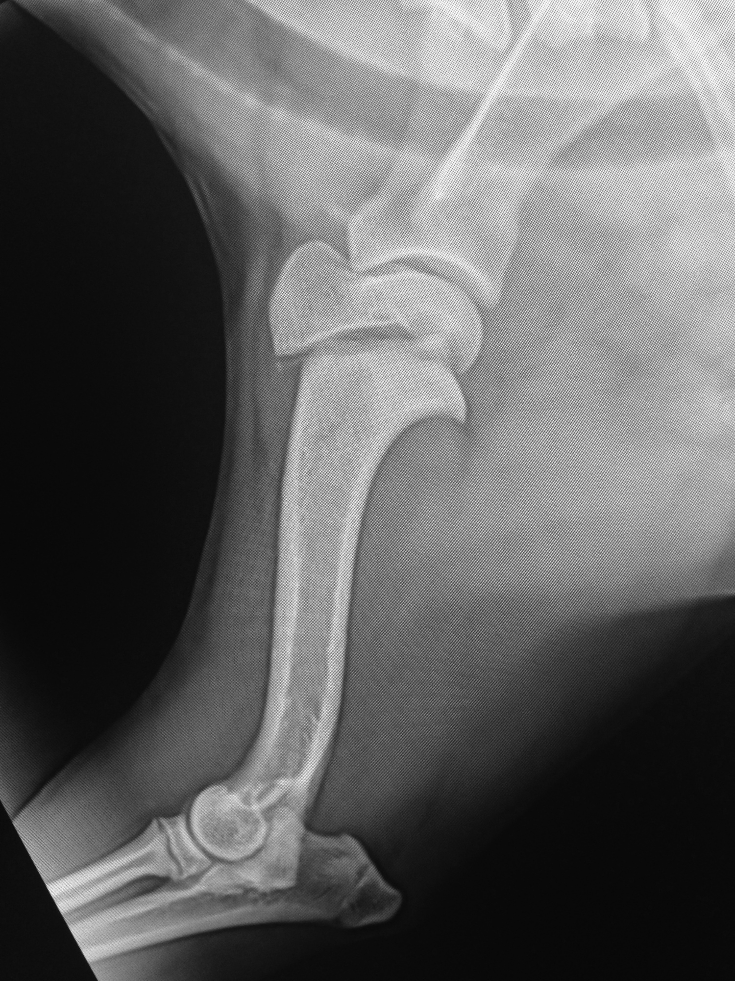 SALTER I FRACTURE PROXIMAL HUMERUS