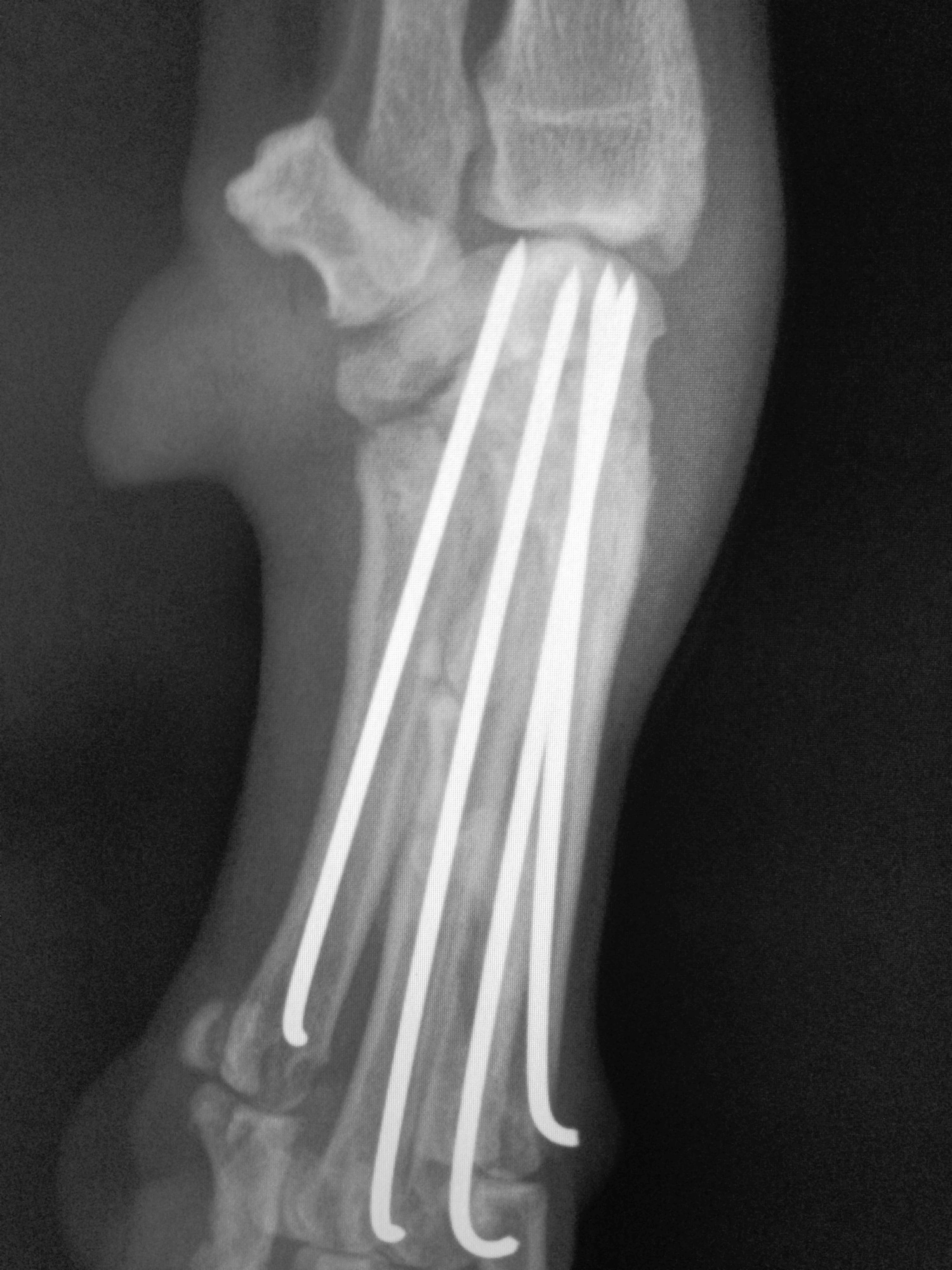 HEALED CARPAL ARTHRODESIS BEFORE IMPLANT REMOVAL