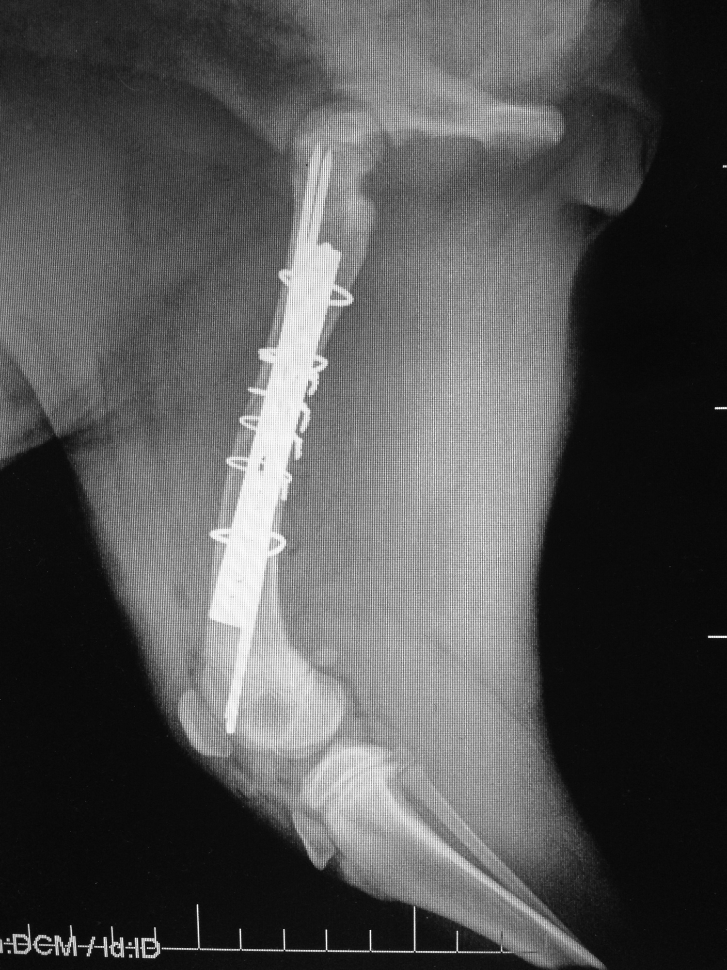 FEMORAL FRACTURE POSTOP PLATE/ROD TECHNIQUE