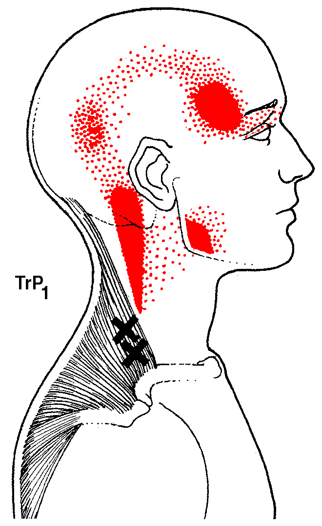 Trigger Point Referral pattern