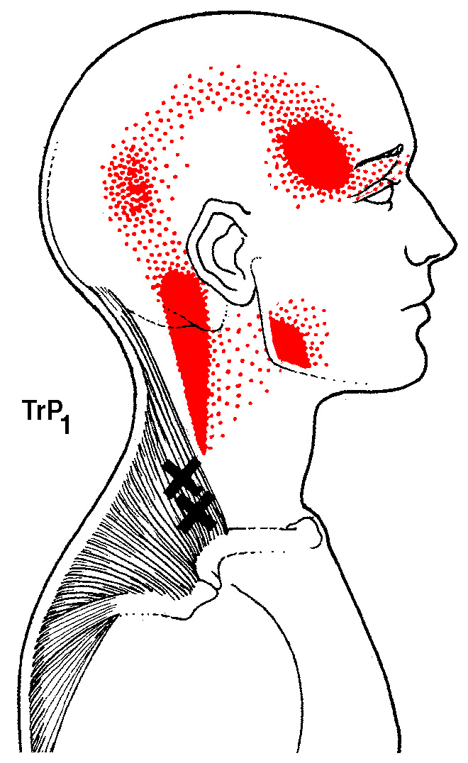 Trigger Point Therapy — Injury Therapy Pro
