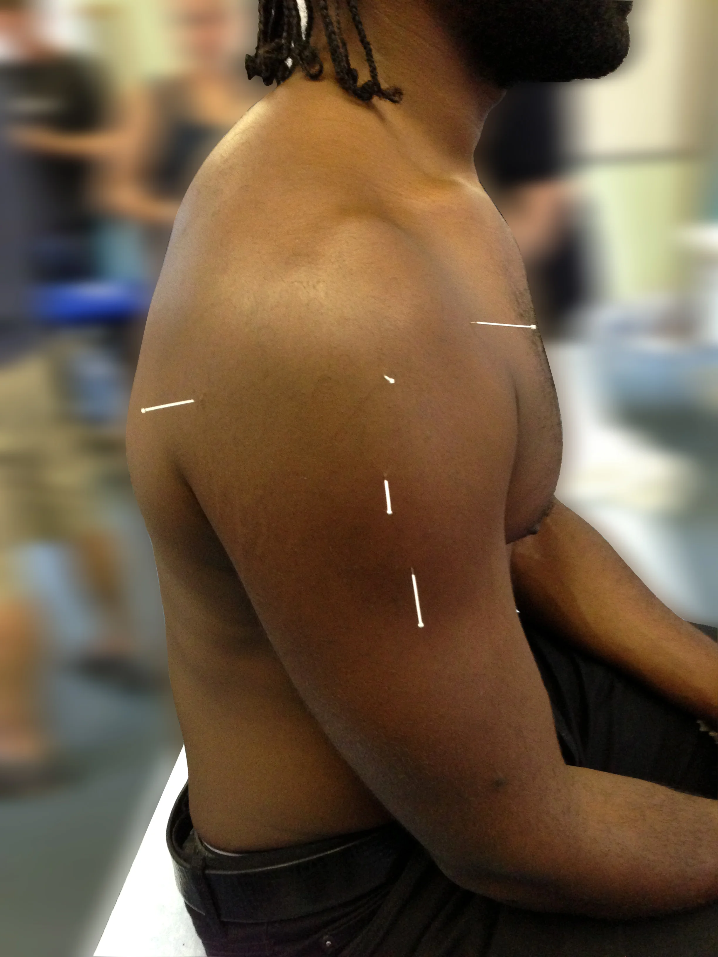 Acupuncture to the upper arm