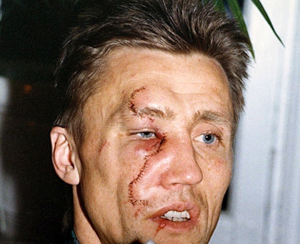 Borje Salming des Leafs de Toronto after getting a skate in the face