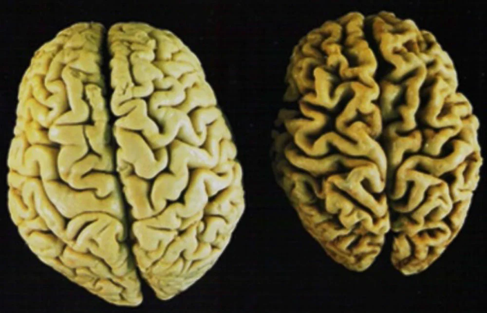 Young Brain vs. Elderly Brain