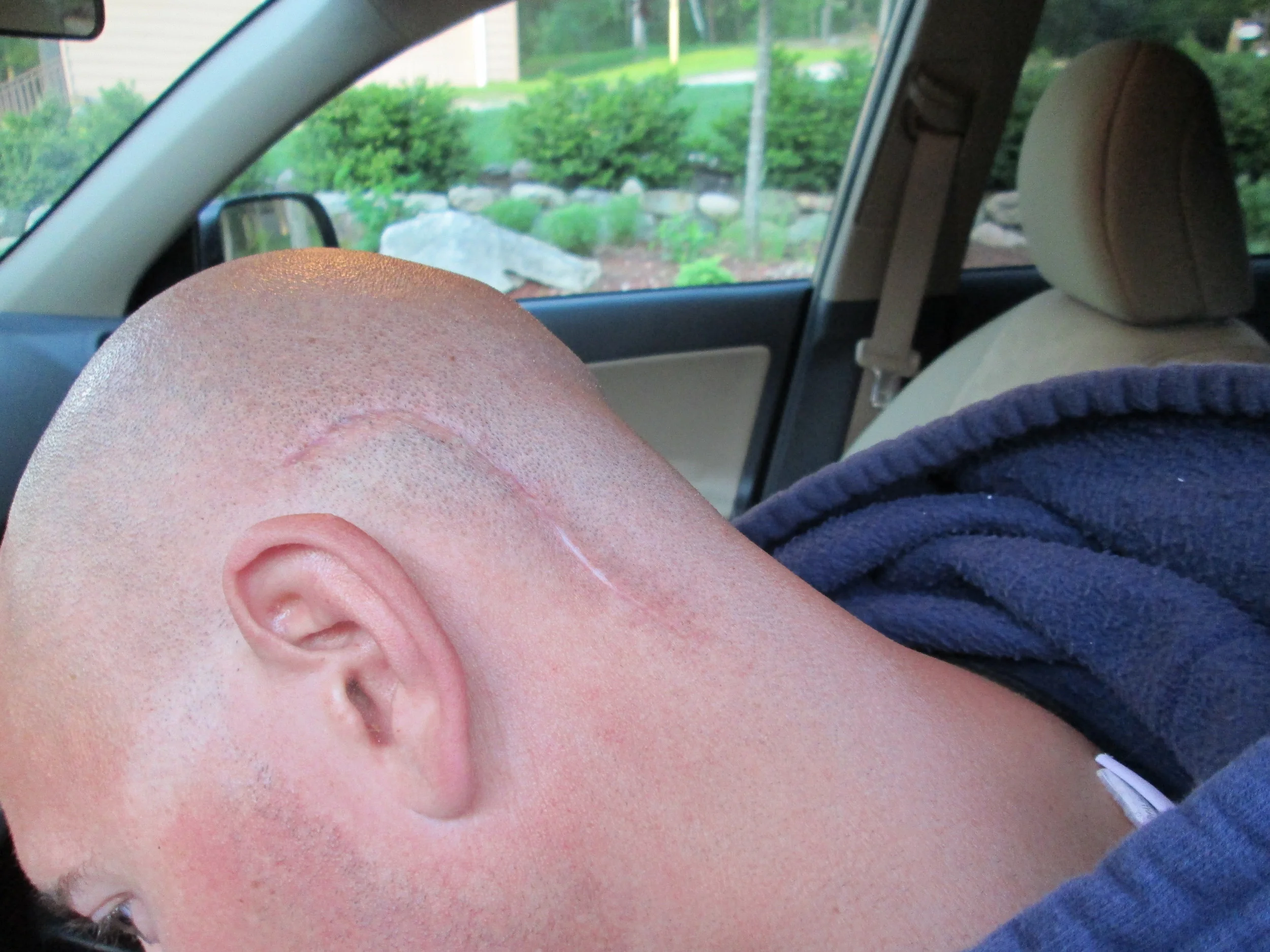 Scar Healing Progress 3 Months Post Surgery