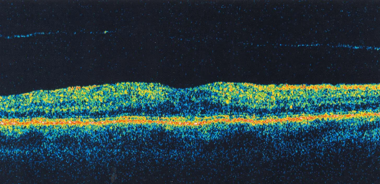 OCT imaging at Brad Abrahams