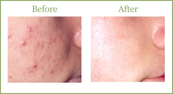 acne2.jpg